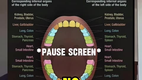 Wisdom Teeth Removal?