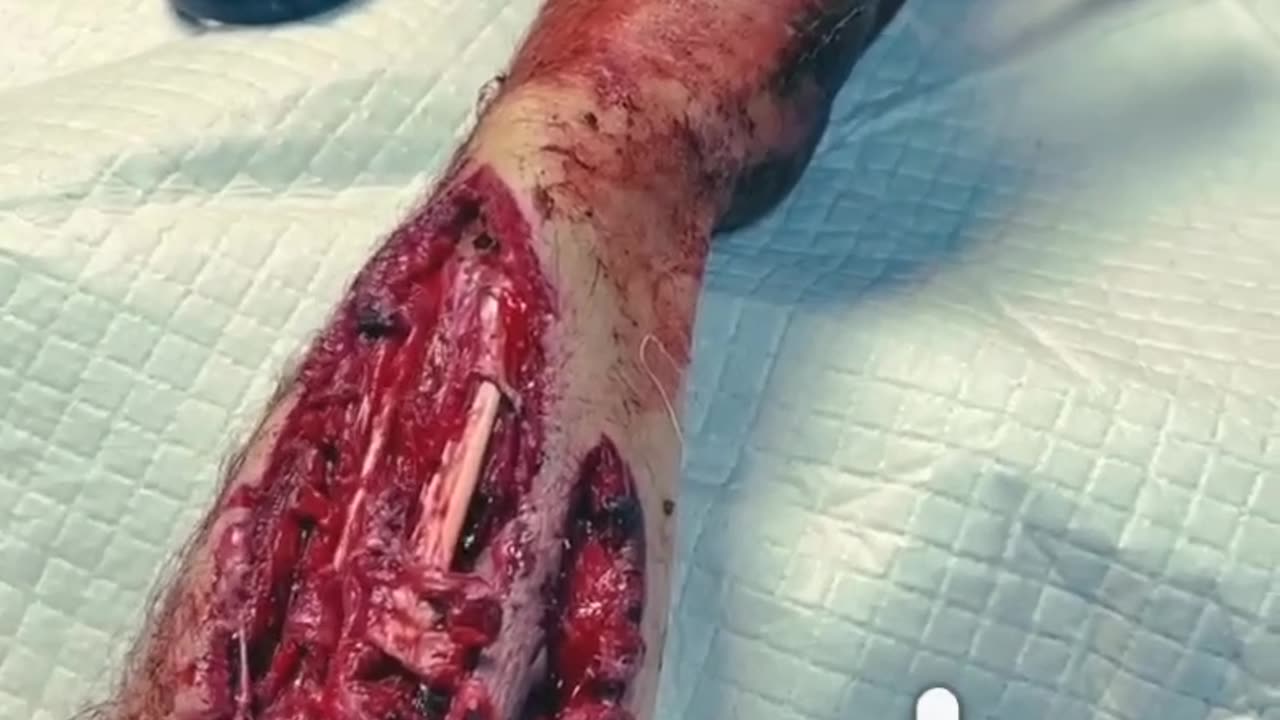 Multiple shrapnel tangent wounds to the right forearm