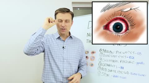 DrBerg-Nutritional Symptoms From Eyes
