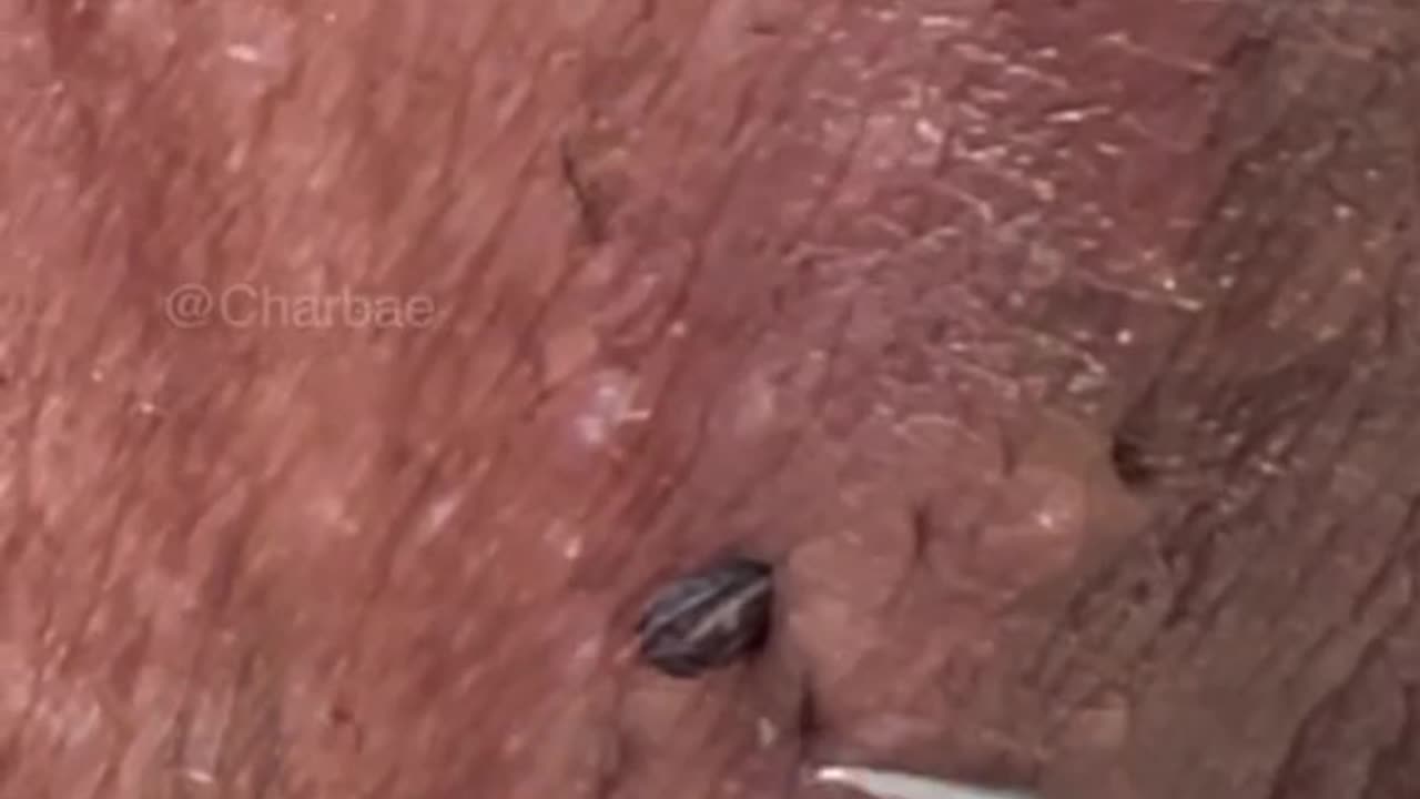 Ingrown hair remowal