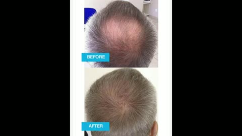 Hair loss Treatment