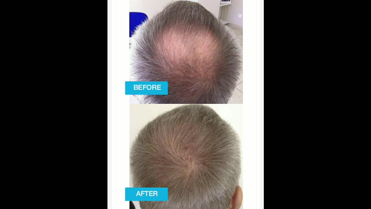 Hair loss Treatment