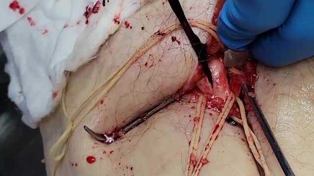 Unbelievable blood clots: video from embalmer Richard Hirschman