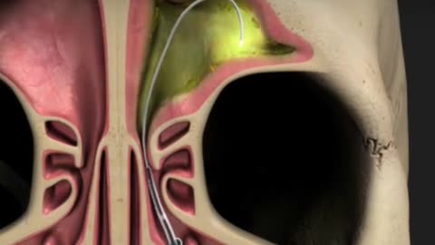 Do You Knw That Why Balloon Sinuplasty Is Performed? | Balloon Sinuplasty 3D Animation