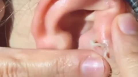 pimple squeeze