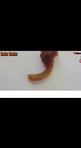 😱 CEREBRUM VERMIS OR “BRAIN” WORM 🐛 REMOVED FROM PATIENT 🪱