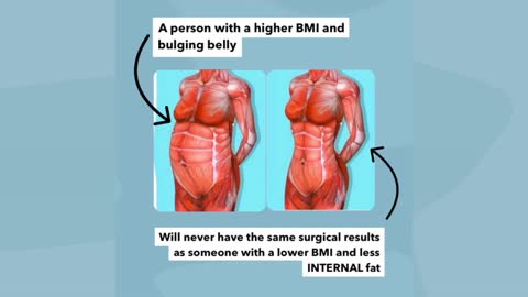 Understanding Internal vs External Fat and Liposuction [VISUAL GUIDE]