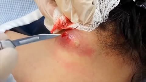 So satisfying HUGE cyst popping on her NECK!