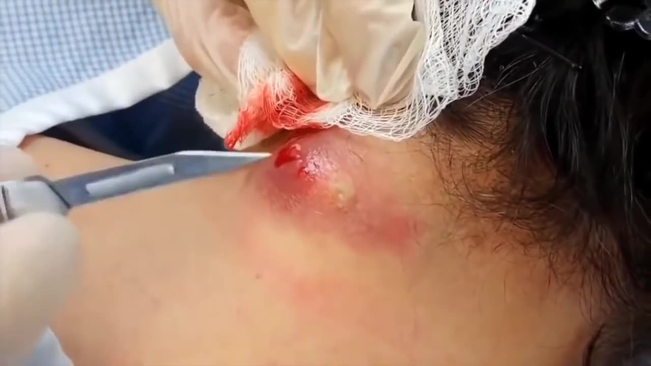 So satisfying HUGE cyst popping on her NECK!