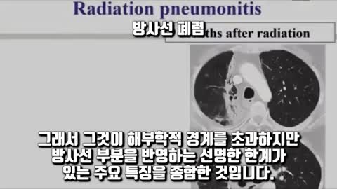 5G 방사능 질환 증상