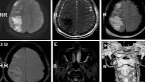 Warning Signs You Have A Brain Tumor Know The Risks!