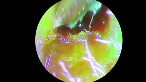 gigantic ear wax removal #39