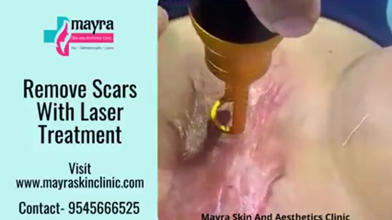 Erase Scars with Laser Treatment: A Modern Solution