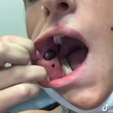 Many have this blood clot problem after vaccination and no doctor can help them.