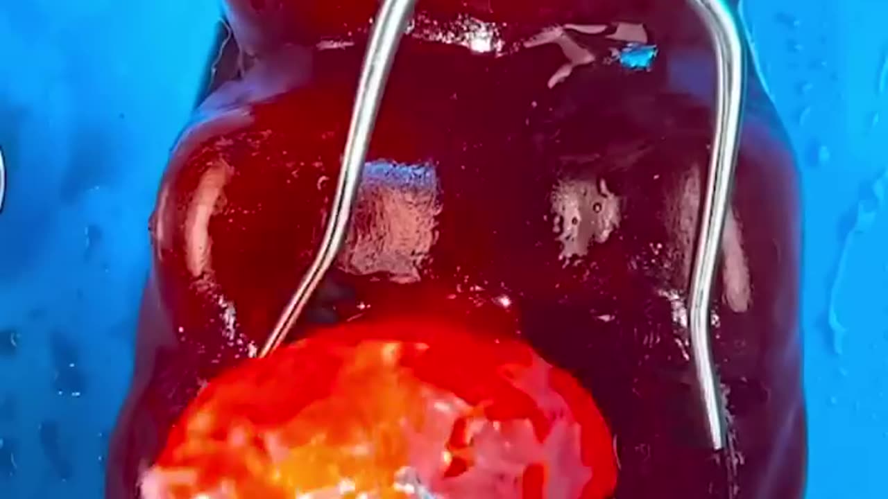 Emergency FruitSurgery! Worlds Largest Gummy Bear has 36 babies! 💔😓