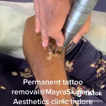 Experience Pain-Free and Safe Permanent Tattoo Removal with No Downtime