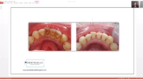 Best way to make your teeth white!