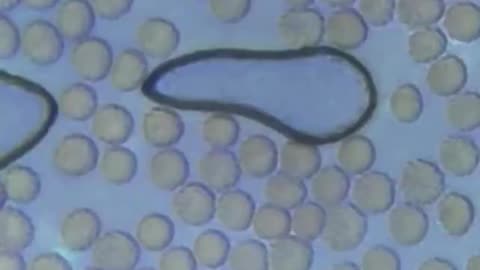 Blood Clot - Lyndsey’s blood and there’s tons of hydrogel in it - sep'23