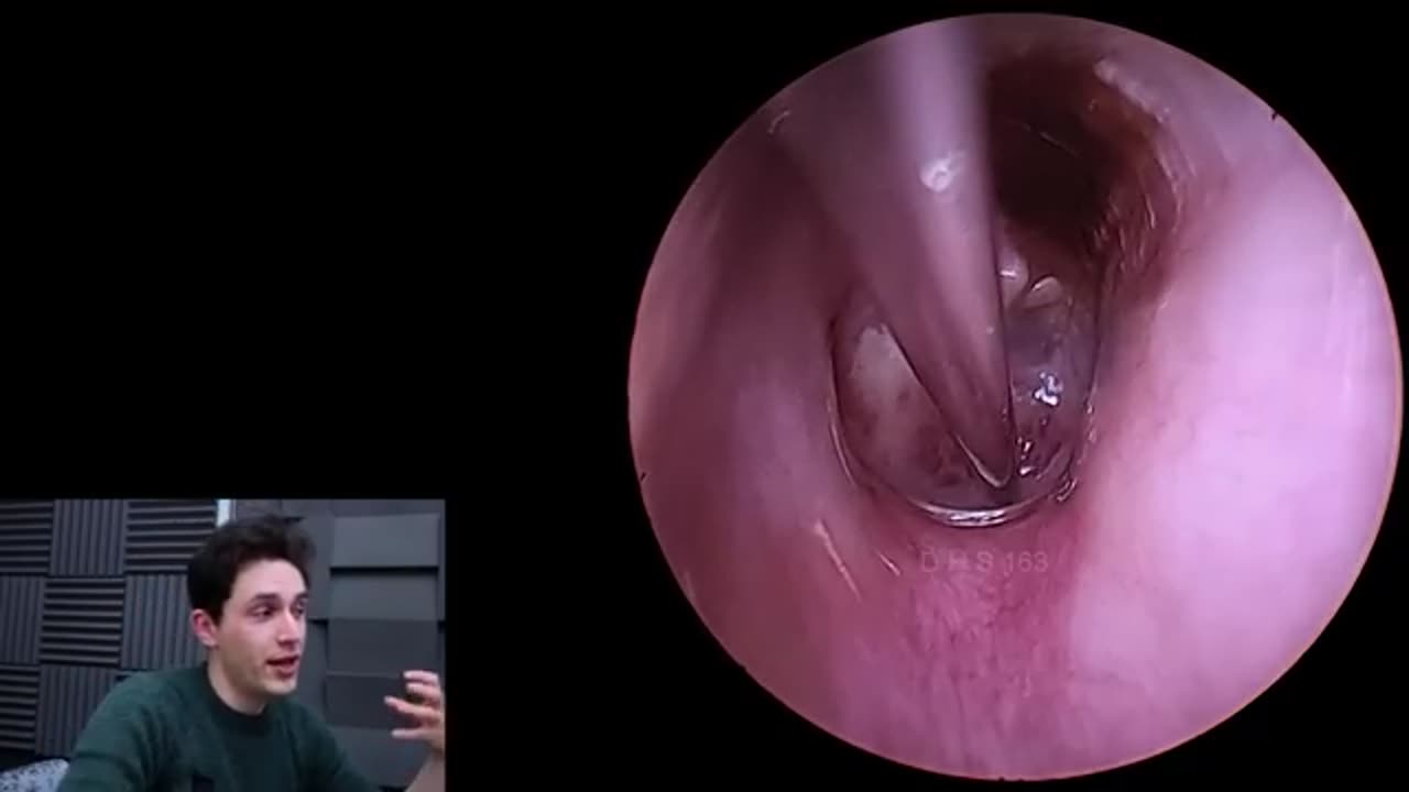 Chronically infacted Eardrum (Granular Myringitis)