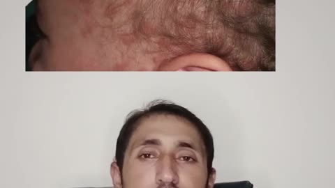 Tinea capitis scalp | fungal infection