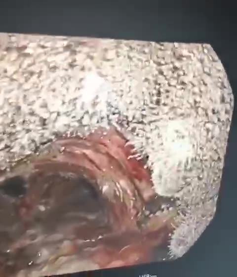 Post-vaccine vascular operation- shows strange mushroom-like structures