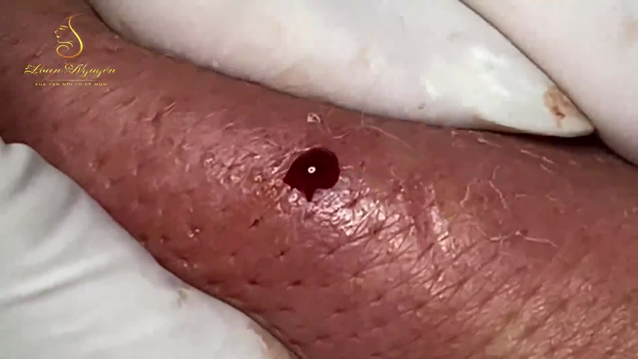 ( Super Big Pimples - Part 3 ) Make Your Day Relaxing with Loan Nguyen Official #371