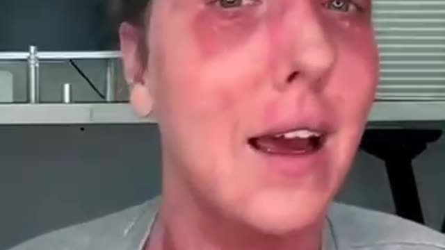 Woman injured by the Covid-19 vaccine EXPOSED