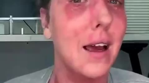 Woman injured by the Covid-19 vaccine EXPOSED