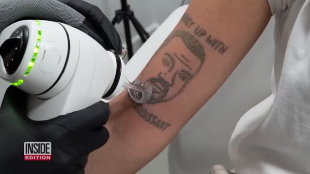 Kanye West Tattoos Removed for Free