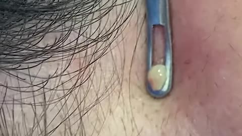 #shorts Pimple Popping by Dermatologist Dr. Timothy Jochen CONTOUR DERMATOLOGY