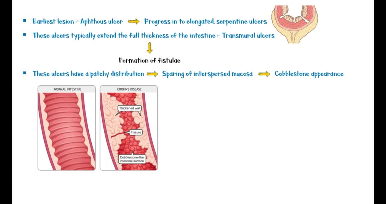 Crohn's Disease _ Causes, Pathogenesis, Clinical Presentation, Diagnosis & Treatment