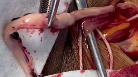 A white fibrous clot caused by the Covid Jab is removed from the right jugular vein..