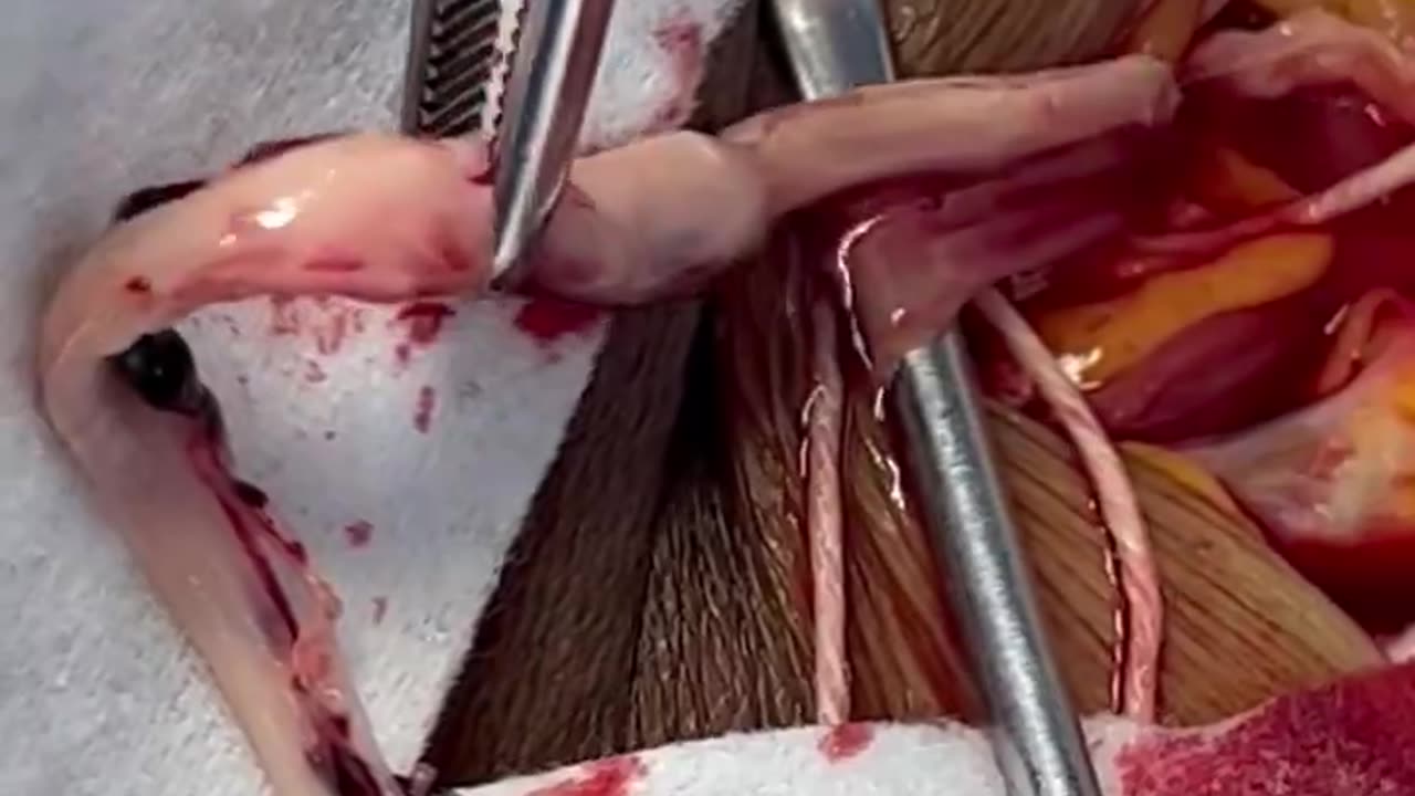 A white fibrous clot caused by the Covid Jab is removed from the right jugular vein..