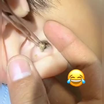 Acne 2021#acneremoved for skin