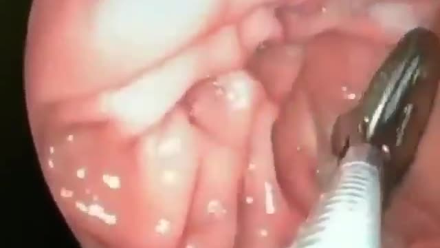 Extracción de cuerpos extraños