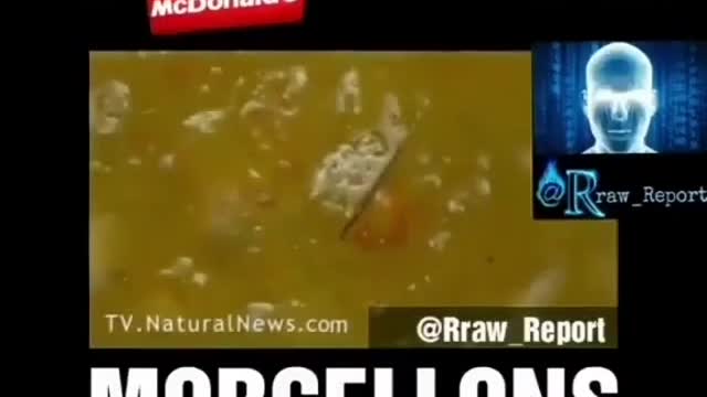 McDonalds food and Morgellons disease