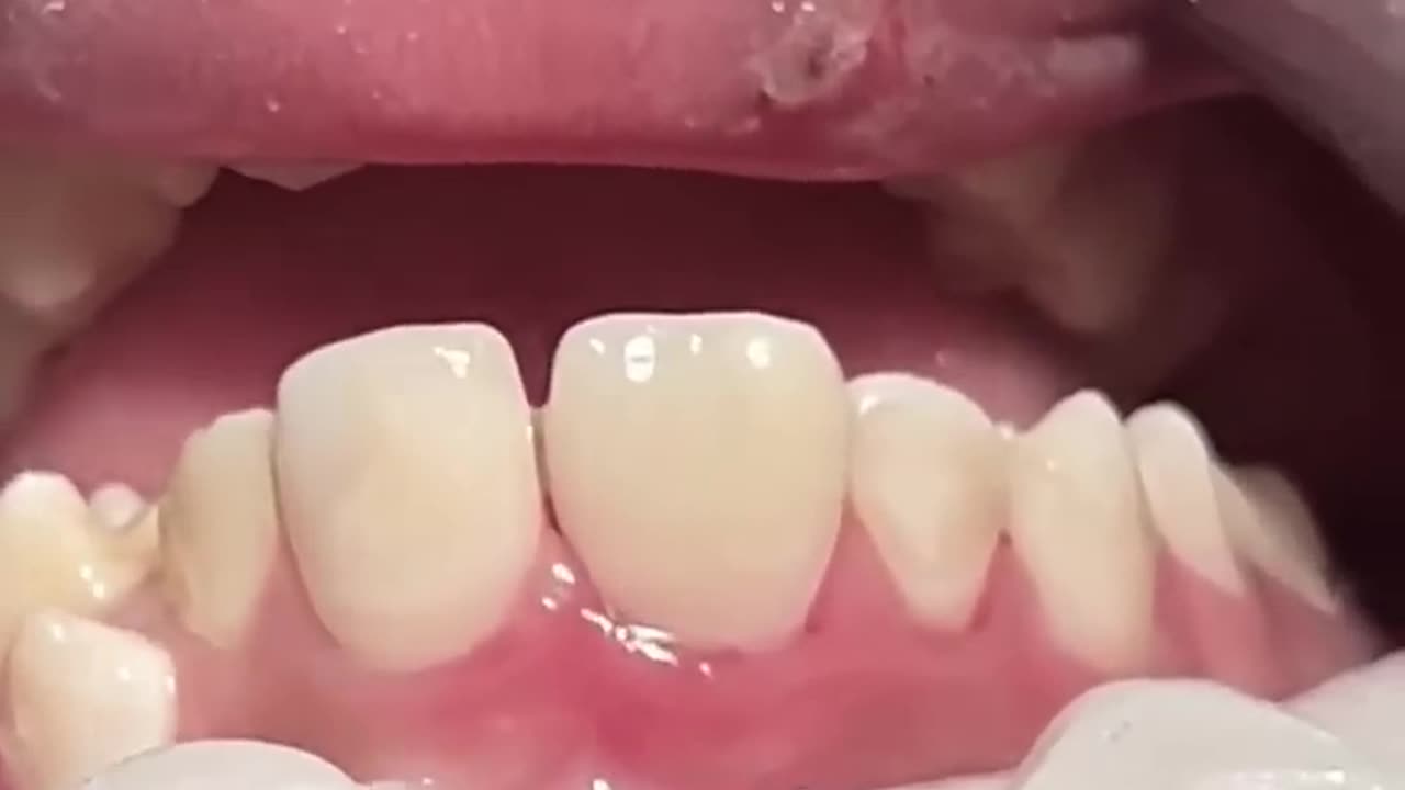 Composite restoration #dentist