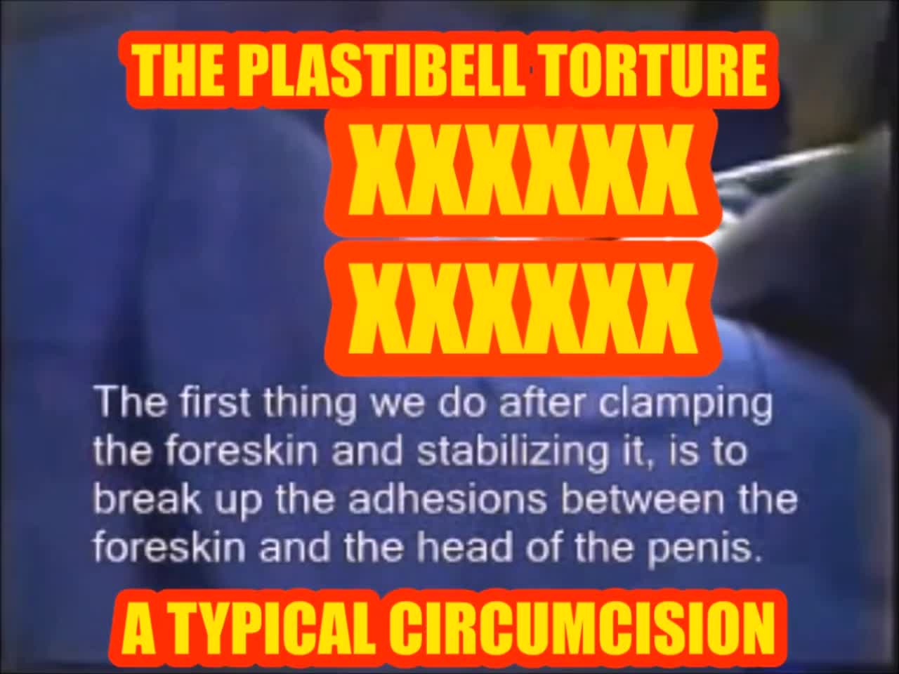 What You Should Know About Plastibell Circumcision