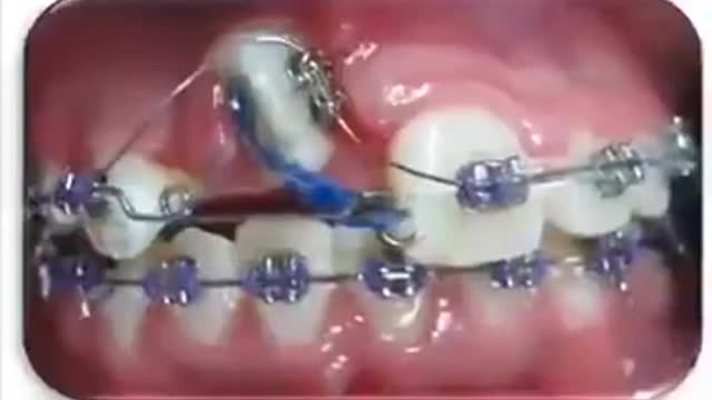 Braces can do wonders