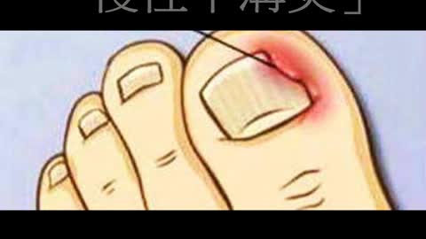 防疫勤洗手 「慢性甲溝炎」