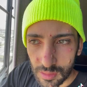 TikTok user describes having Monkeypox