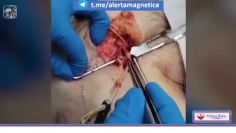 דר גין רובי והחנט מוציאים קרישי דם מרגל של בנאדם זהירות קשה לצפייה