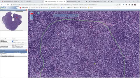 index case, 3B, lymphoma, dlbcl