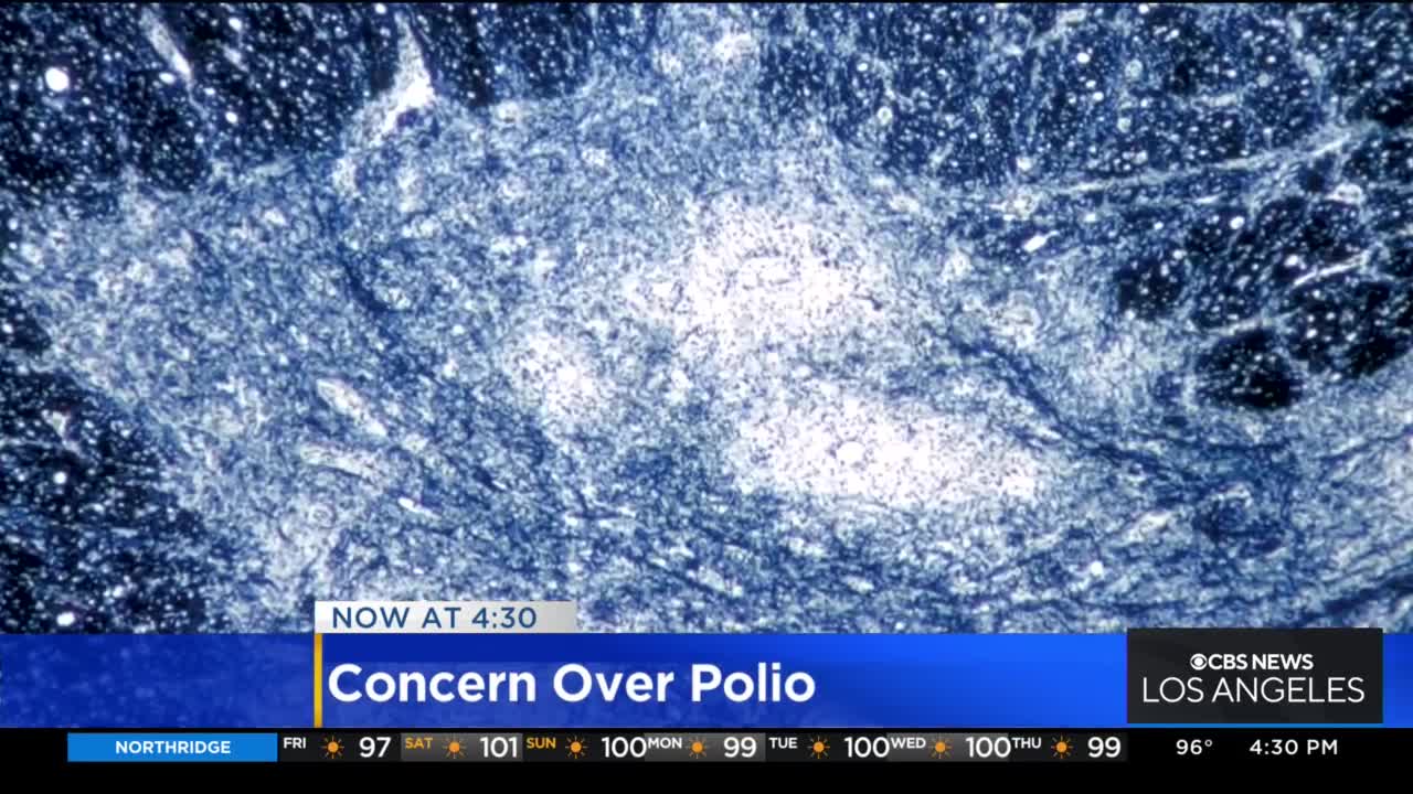 Concern over polio grows after New York health officials discover virus in wastewater