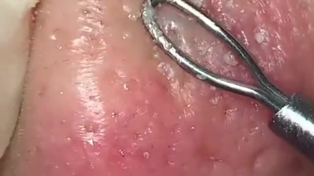 Pimple Popping