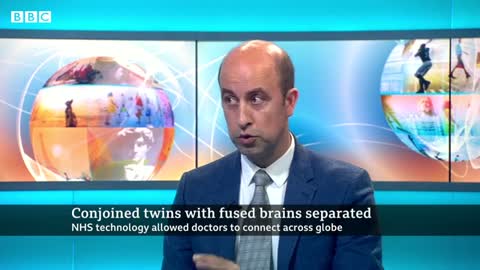 Conjoined twin separated with the help of virtual reality