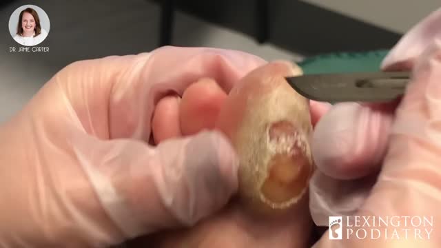 SMOOTH + SATISFYING CALLUS TRIM