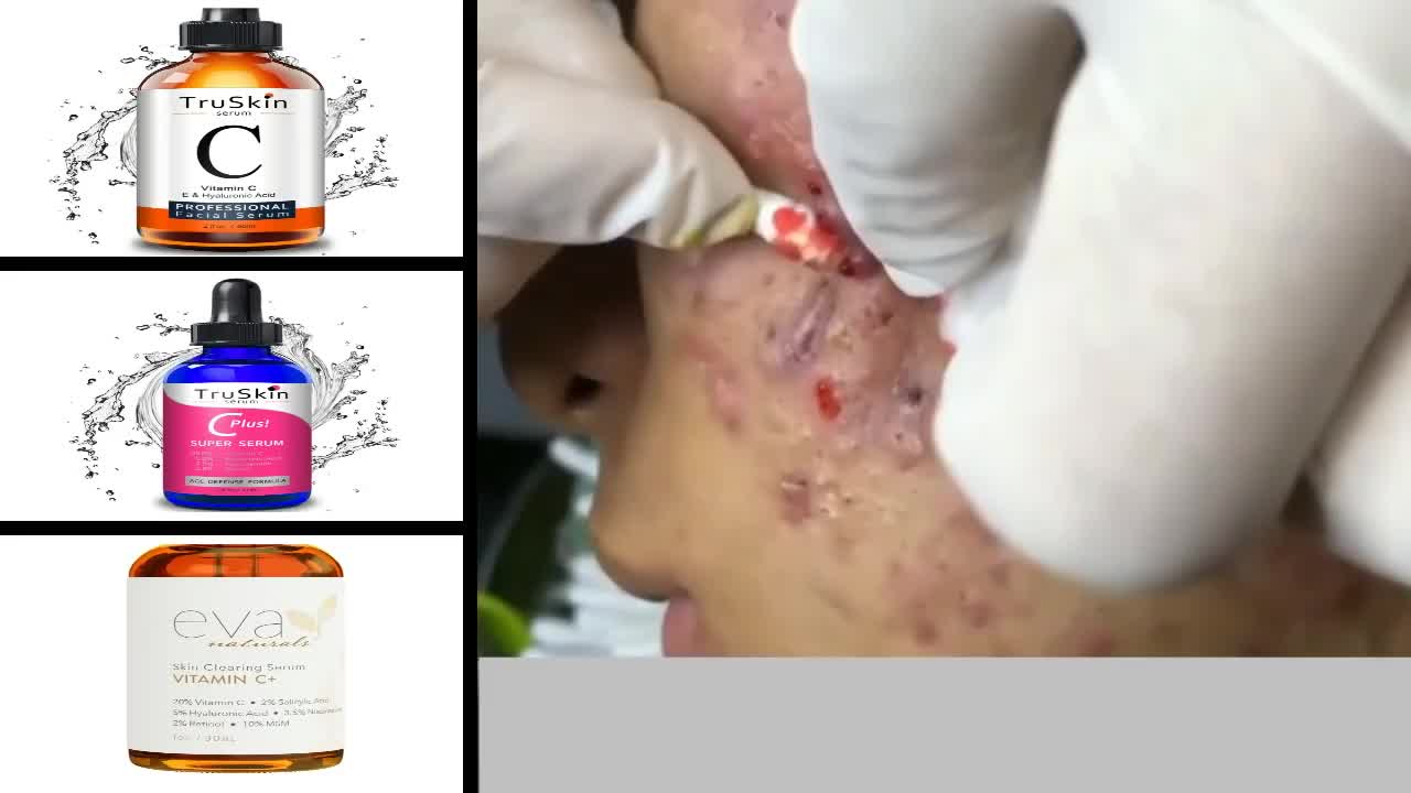 Satisfying pimple popping/removal video