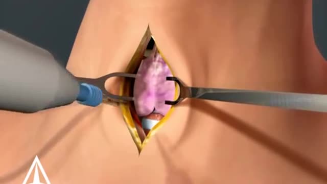 Tracheotomy - 3D Medical Animation