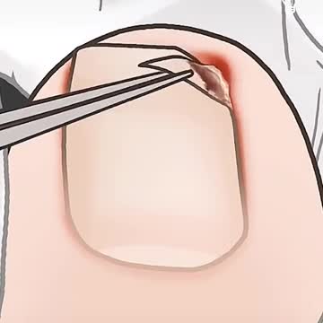 Removing ingrown toenail (animated)